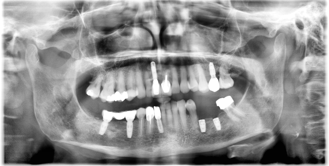 Radiographie panoramique dentaire